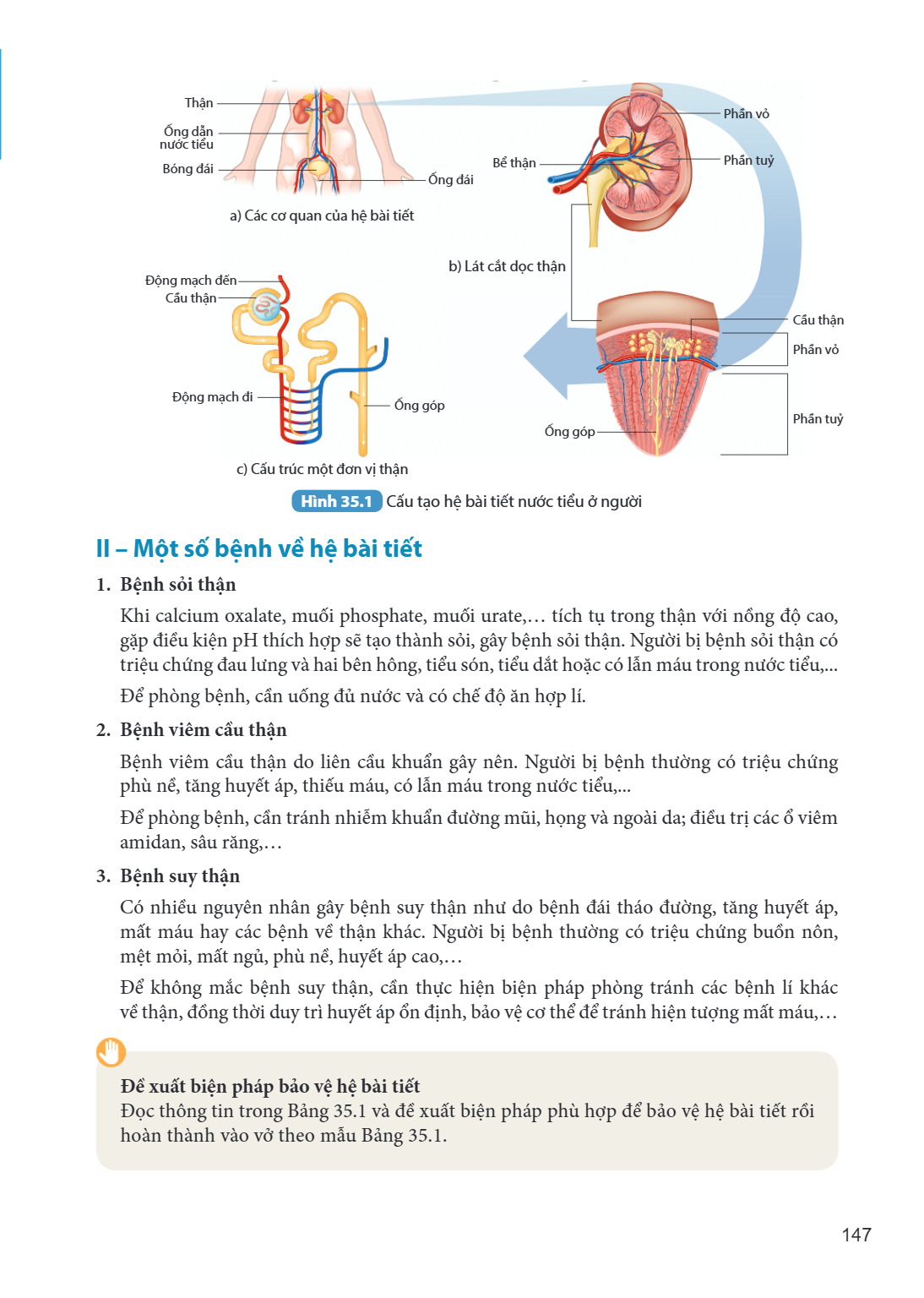 Hình 35.1 Cấu tạo hệ bài tiết nước tiểu ở người II – Một số bệnh về hệ bài tiết 1. Bệnh sỏi thận Khi calcium oxalate, muối phosphate, muối urate,... tích tụ tro